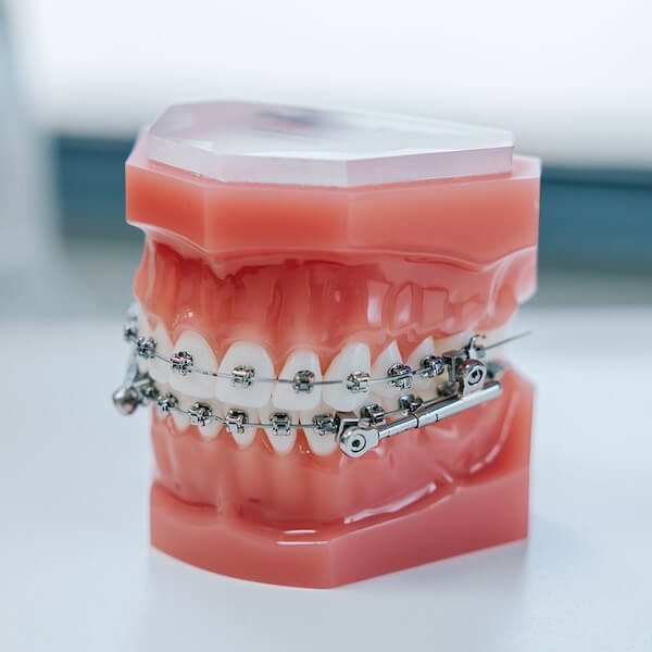 Orthodontie - beugel - tandartspraktijk de Waard Terheijden - Breda.